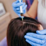 haartransplantatie